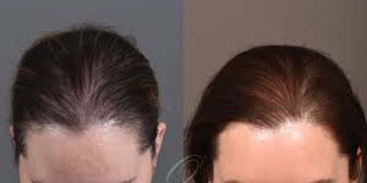 Hairline Lowering Surgery Explained: Who It’s For and What to Expect